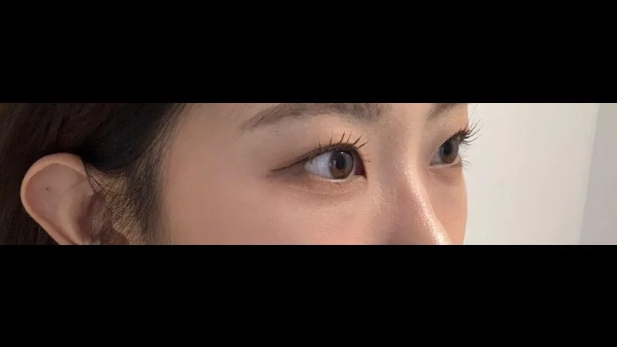 Natural Adhesion Double Eyelid Surgery, Lower Eyelid Fat Repositioning, Lower Eyelid Fat Grafting — RE&RE PLASTIC SURGERY 4