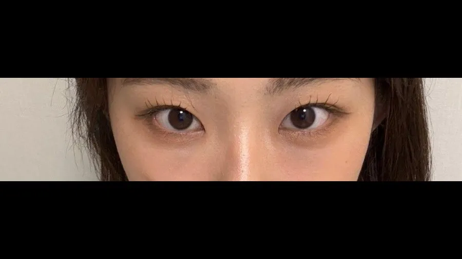 Natural Adhesion Double Eyelid Surgery, Lower Eyelid Fat Repositioning, Lower Eyelid Fat Grafting — RE&RE PLASTIC SURGERY 6