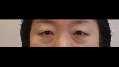 Sub-brow Lift, Ptosis Correction, Full-Face Thread lift 1