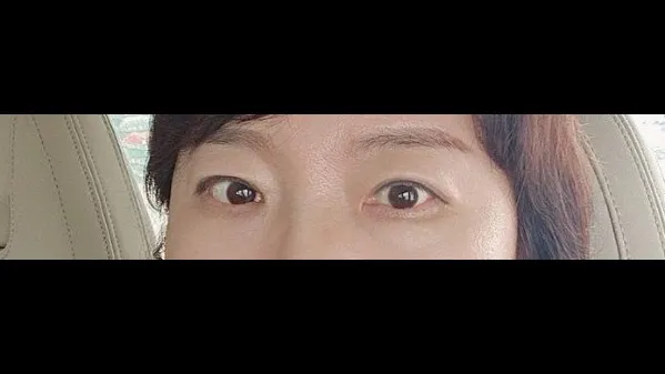 Sub-brow Lift, Ptosis Correction, Full-Face Thread lift 2