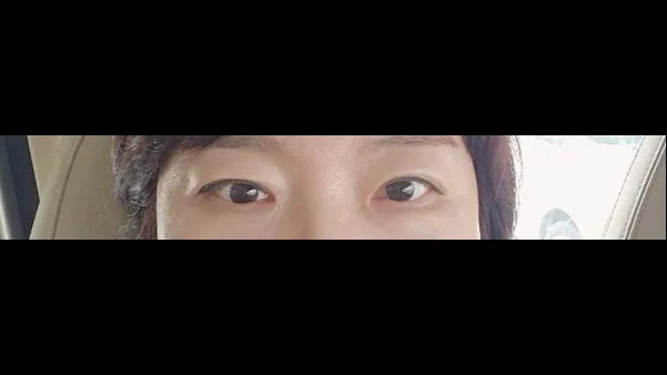 Sub-brow Lift, Ptosis Correction, Full-Face Thread lift — RE&RE PLASTIC SURGERY 4