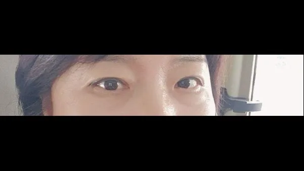 Sub-brow Lift, Ptosis Correction, Full-Face Thread lift — RE&RE PLASTIC SURGERY 5