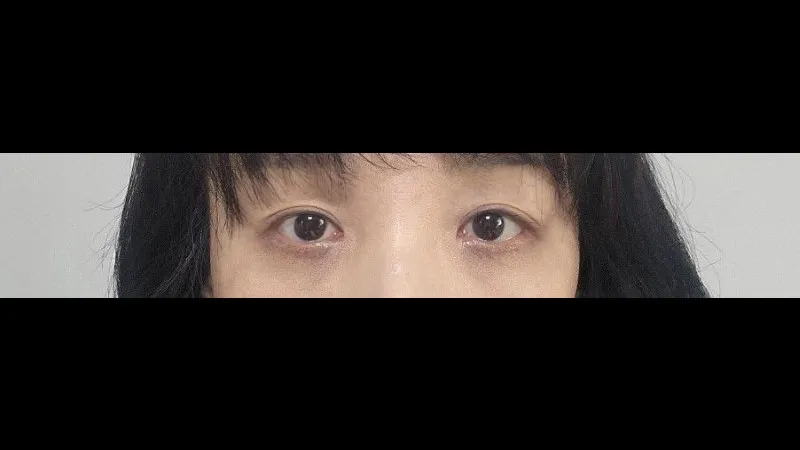 Sub-brow Lift, Ptosis Correction — RE&RE PLASTIC SURGERY 2