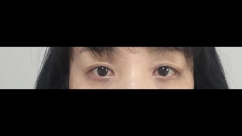 Sub-brow Lift, Ptosis Correction — RE&RE PLASTIC SURGERY 3