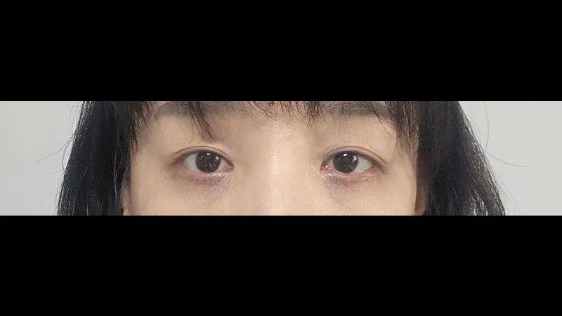 Sub-brow Lift, Ptosis Correction — RE&RE PLASTIC SURGERY 4