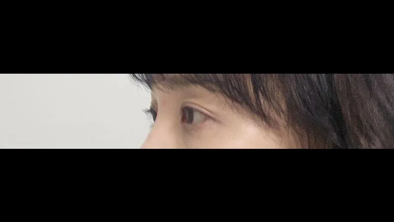 Sub-brow Lift, Ptosis Correction — RE&RE PLASTIC SURGERY 5