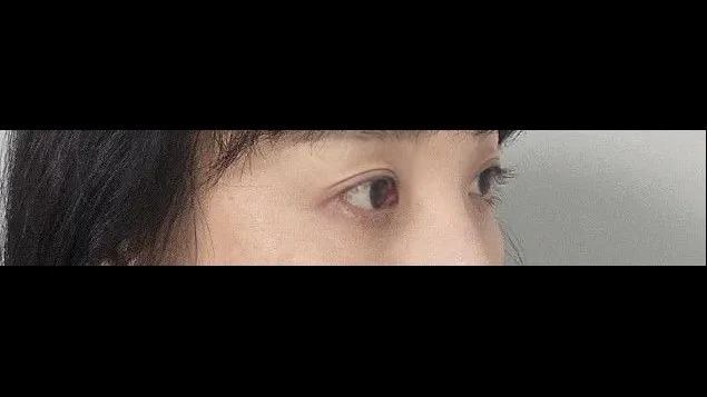 Sub-brow Lift, Ptosis Correction — RE&RE PLASTIC SURGERY 6