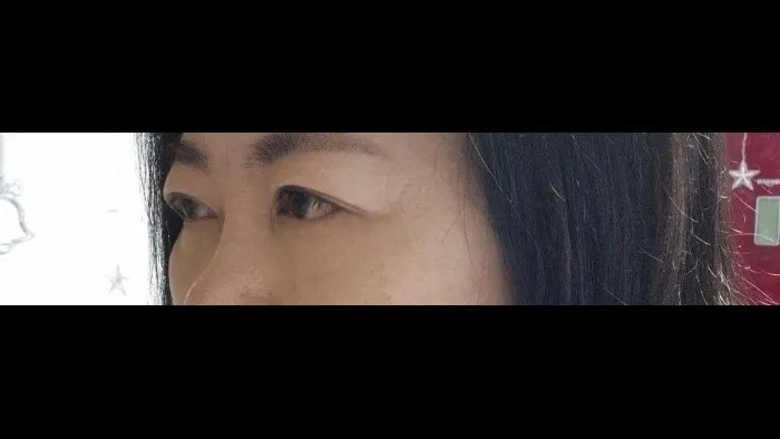 Sub-brow Lift, Lower Blepharoplasty (Aging Eye Rejuvenation) — RE&RE PLASTIC SURGERY 2