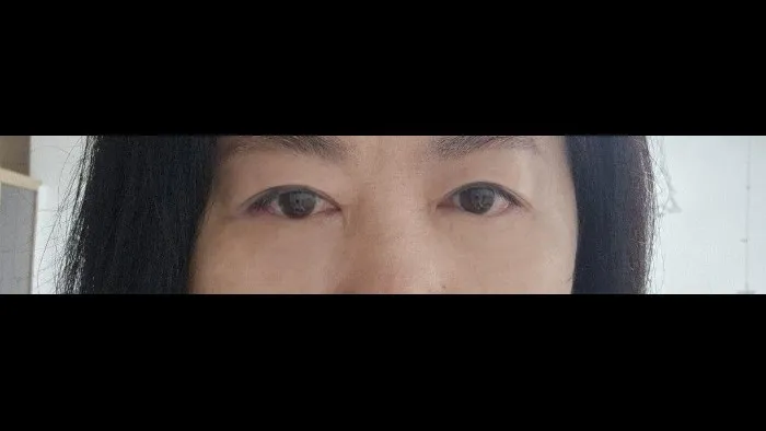 Sub-brow Lift, Lower Blepharoplasty (Aging Eye Rejuvenation) — RE&RE PLASTIC SURGERY 3