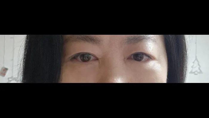 Sub-brow Lift, Lower Blepharoplasty (Aging Eye Rejuvenation) — RE&RE PLASTIC SURGERY 4