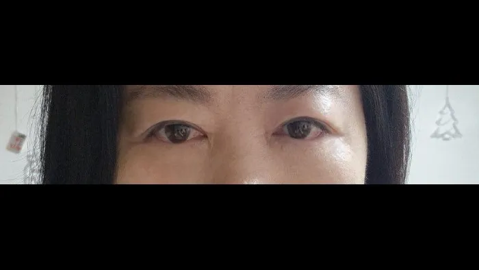 Sub-brow Lift, Lower Blepharoplasty (Aging Eye Rejuvenation) — RE&RE PLASTIC SURGERY 5