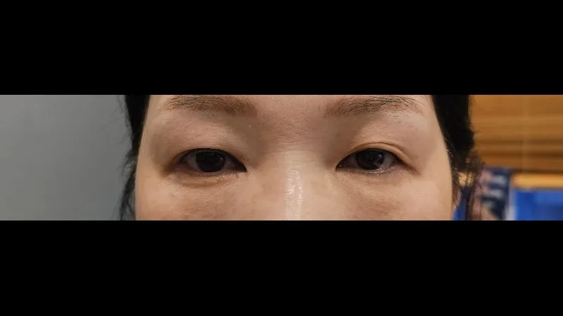 Natural Adhesion Double Eyelid Surgery — RE&RE PLASTIC SURGERY 1