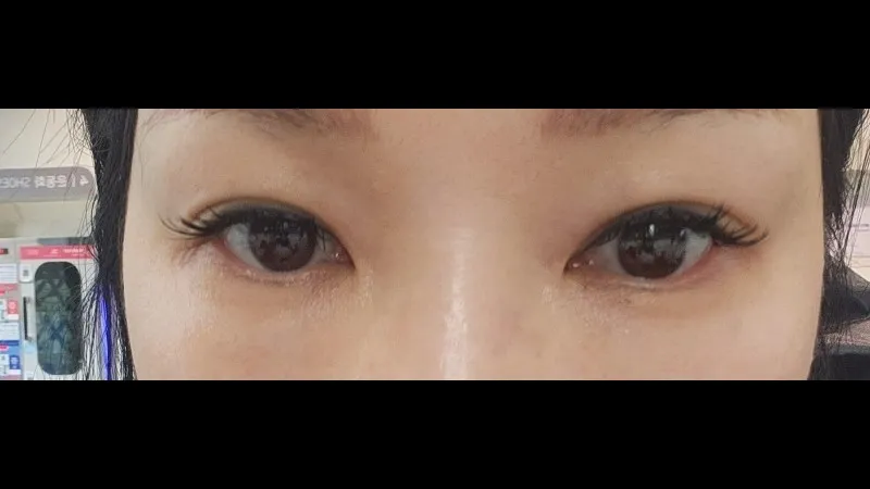 Natural Adhesion Double Eyelid Surgery — RE&RE PLASTIC SURGERY 2