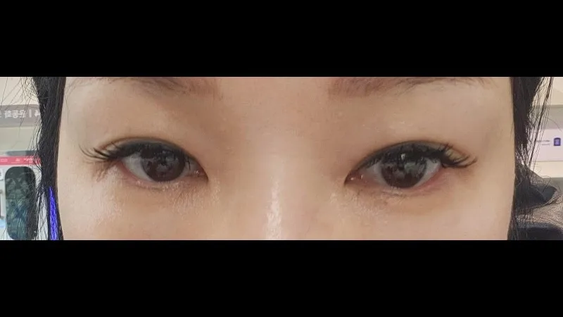 Natural Adhesion Double Eyelid Surgery — RE&RE PLASTIC SURGERY 3