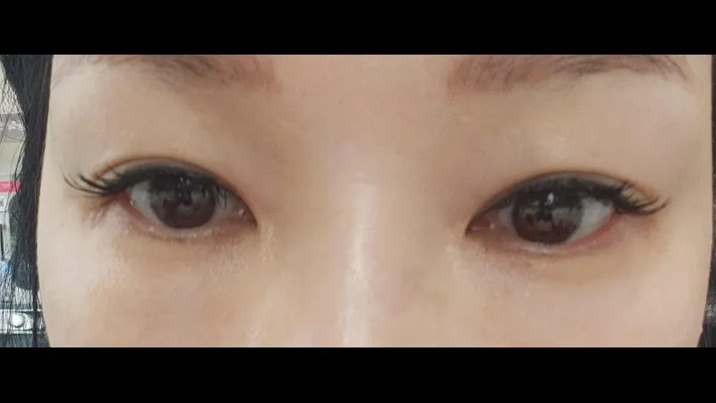 Natural Adhesion Double Eyelid Surgery — RE&RE PLASTIC SURGERY 4
