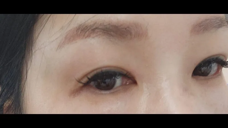 Natural Adhesion Double Eyelid Surgery — RE&RE PLASTIC SURGERY 6