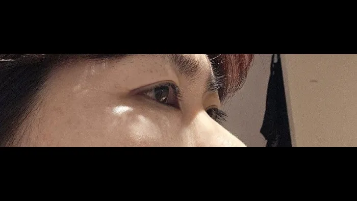 Sub-brow Lift — RE&RE PLASTIC SURGERY 2