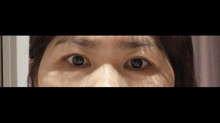 Sub-brow Lift — RE&RE PLASTIC SURGERY 3