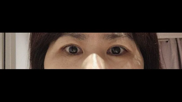Sub-brow Lift — RE&RE PLASTIC SURGERY 4