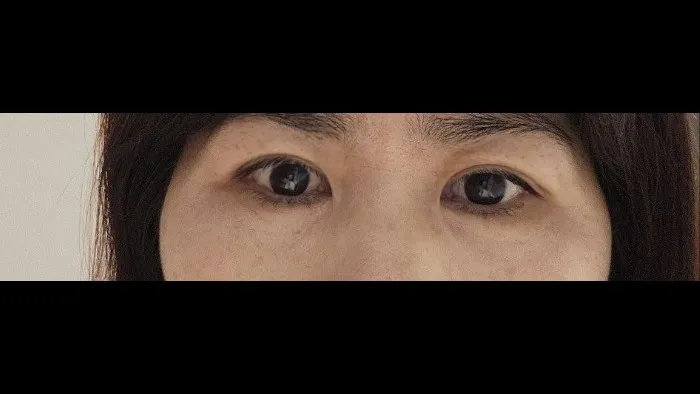 Sub-brow Lift — RE&RE PLASTIC SURGERY 5