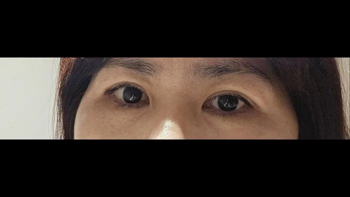 Sub-brow Lift — RE&RE PLASTIC SURGERY 6