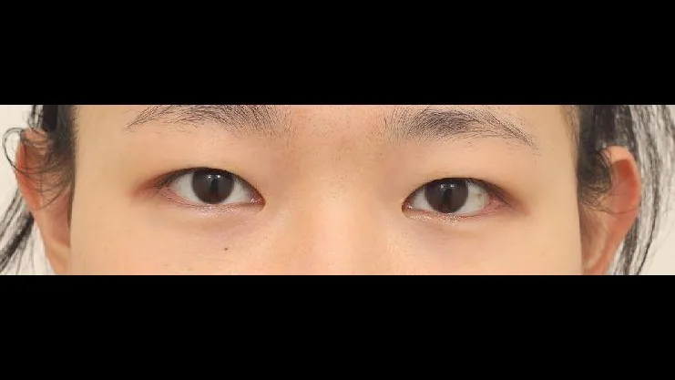 Partial Incision Double Eyelid Surgery, Ptosis Correction 1