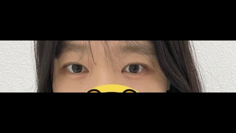 Partial Incision Double Eyelid Surgery, Ptosis Correction 2
