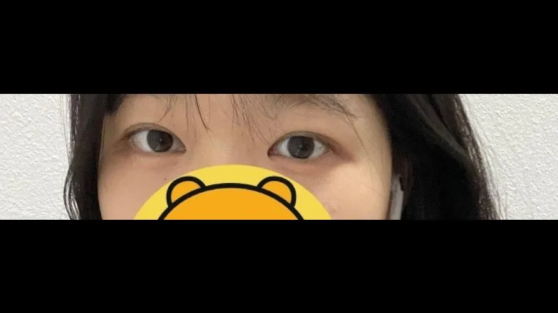 Partial Incision Double Eyelid Surgery, Ptosis Correction — RE&RE PLASTIC SURGERY 3
