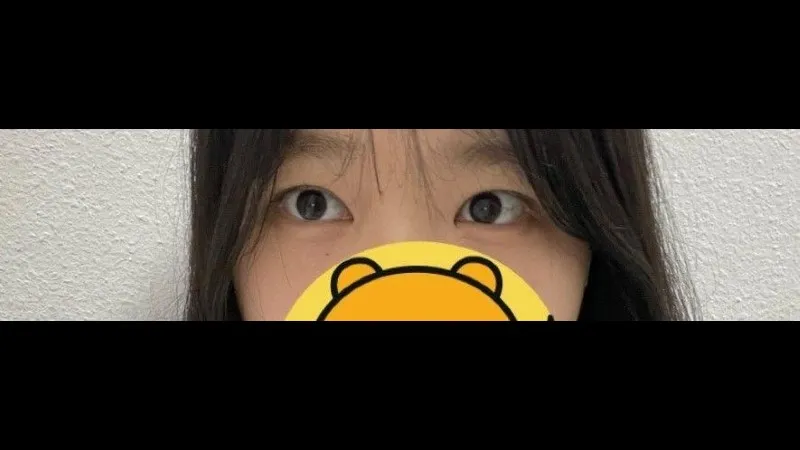 Partial Incision Double Eyelid Surgery, Ptosis Correction — RE&RE PLASTIC SURGERY 4
