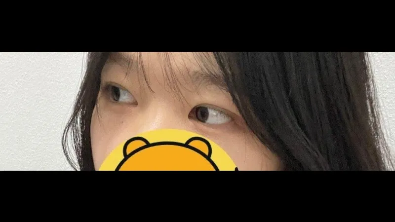 Partial Incision Double Eyelid Surgery, Ptosis Correction — RE&RE PLASTIC SURGERY 5