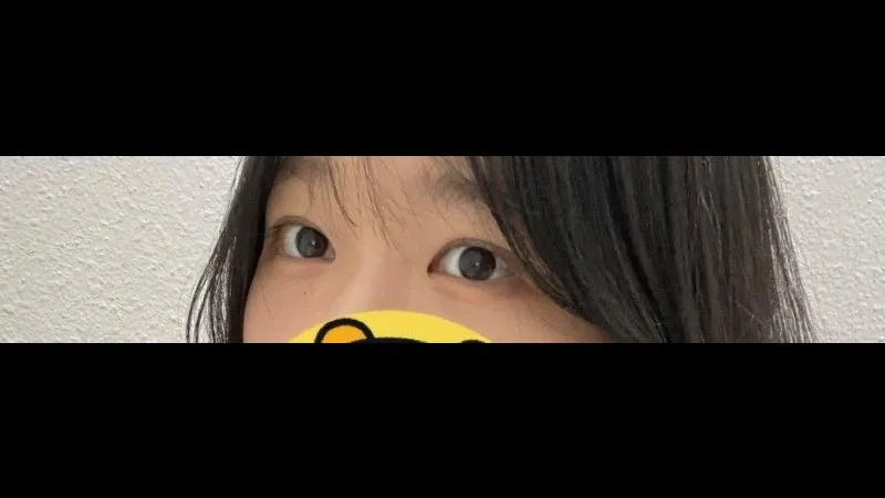 Partial Incision Double Eyelid Surgery, Ptosis Correction — RE&RE PLASTIC SURGERY 6