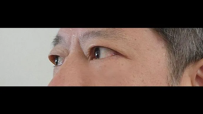 Sub-brow Lift, Lower Blepharoplasty (Aging Eye Rejuvenation) — RE&RE PLASTIC SURGERY 2