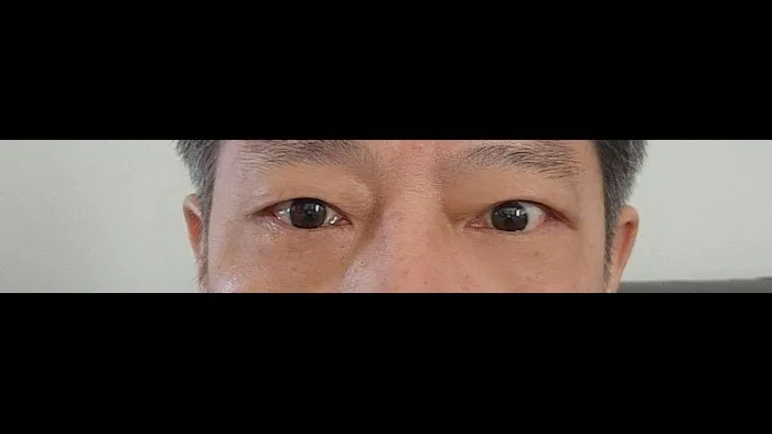 Sub-brow Lift, Lower Blepharoplasty (Aging Eye Rejuvenation) — RE&RE PLASTIC SURGERY 3