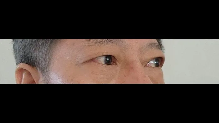 Sub-brow Lift, Lower Blepharoplasty (Aging Eye Rejuvenation) — RE&RE PLASTIC SURGERY 4