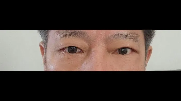 Sub-brow Lift, Lower Blepharoplasty (Aging Eye Rejuvenation) — RE&RE PLASTIC SURGERY 5