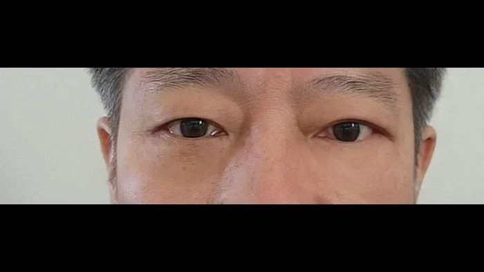 Sub-brow Lift, Lower Blepharoplasty (Aging Eye Rejuvenation) — RE&RE PLASTIC SURGERY 6