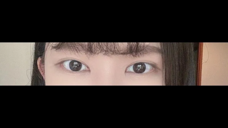 Incisional Double Eyelid Surgery — RE&RE PLASTIC SURGERY 2