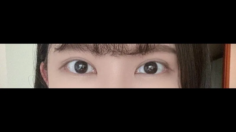 Incisional Double Eyelid Surgery — RE&RE PLASTIC SURGERY 3