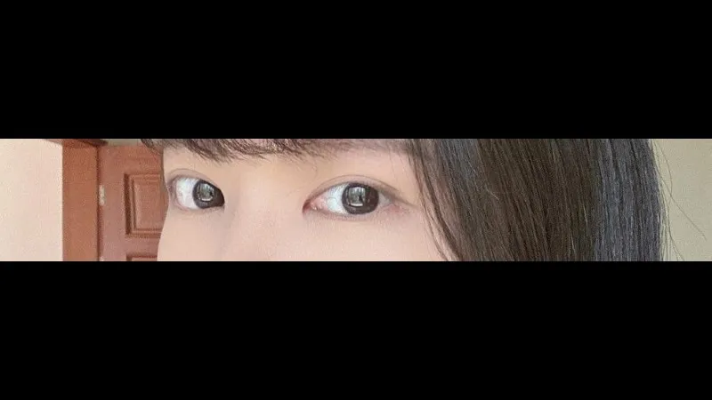 Incisional Double Eyelid Surgery — RE&RE PLASTIC SURGERY 4
