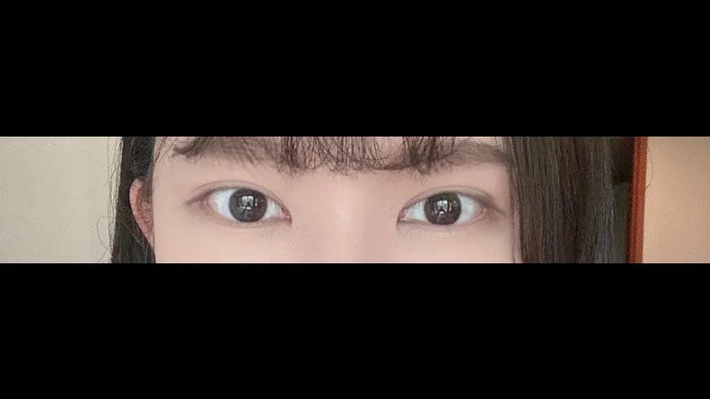 Incisional Double Eyelid Surgery — RE&RE PLASTIC SURGERY 5