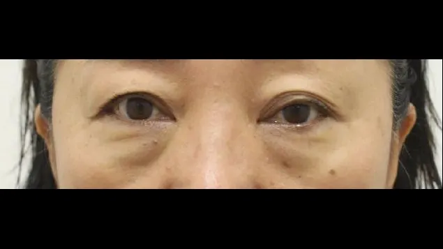 Sub-brow Lift, Lower Eyelid Fat Repositioning, Lower Blepharoplasty (Aging Eye Rejuvenation), Ptosis Correction, Midface Lift, Full-Face Thread lift 1