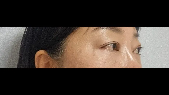 Sub-brow Lift, Lower Eyelid Fat Repositioning, Lower Blepharoplasty (Aging Eye Rejuvenation), Ptosis Correction, Midface Lift, Full-Face Thread lift 2