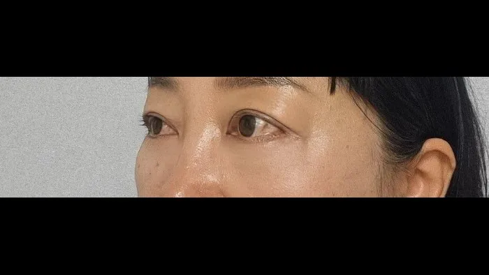 Sub-brow Lift, Lower Eyelid Fat Repositioning, Lower Blepharoplasty (Aging Eye Rejuvenation), Ptosis Correction, Midface Lift, Full-Face Thread lift — RE&RE PLASTIC SURGERY 3