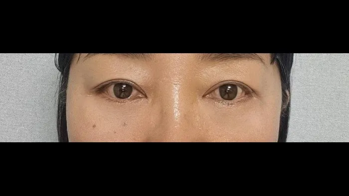 Sub-brow Lift, Lower Eyelid Fat Repositioning, Lower Blepharoplasty (Aging Eye Rejuvenation), Ptosis Correction, Midface Lift, Full-Face Thread lift — RE&RE PLASTIC SURGERY 4