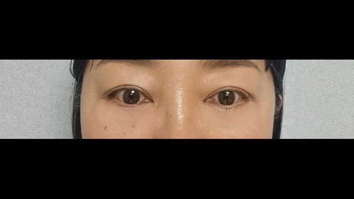 Sub-brow Lift, Lower Eyelid Fat Repositioning, Lower Blepharoplasty (Aging Eye Rejuvenation), Ptosis Correction, Midface Lift, Full-Face Thread lift — RE&RE PLASTIC SURGERY 5