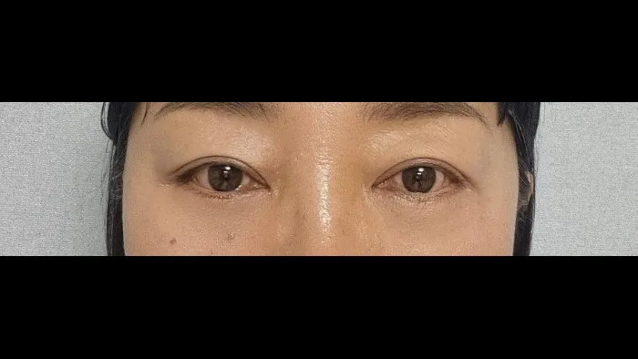 Sub-brow Lift, Lower Eyelid Fat Repositioning, Lower Blepharoplasty (Aging Eye Rejuvenation), Ptosis Correction, Midface Lift, Full-Face Thread lift — RE&RE PLASTIC SURGERY 6