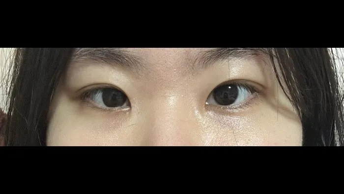 Natural Adhesion Double Eyelid Surgery, Ptosis Correction — RE&RE PLASTIC SURGERY 2