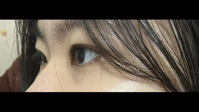 Natural Adhesion Double Eyelid Surgery, Ptosis Correction — RE&RE PLASTIC SURGERY 3