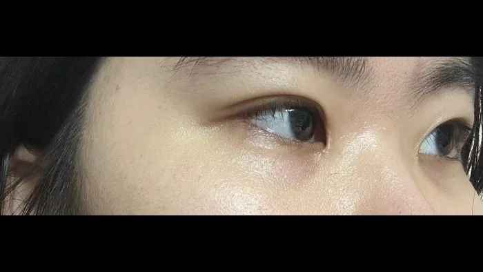 Natural Adhesion Double Eyelid Surgery, Ptosis Correction — RE&RE PLASTIC SURGERY 4