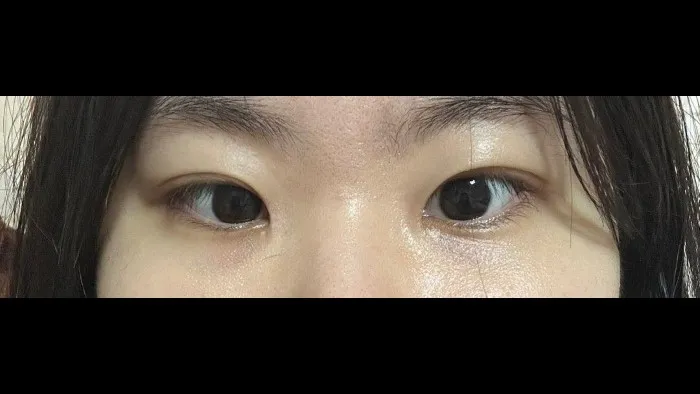 Natural Adhesion Double Eyelid Surgery, Ptosis Correction — RE&RE PLASTIC SURGERY 5